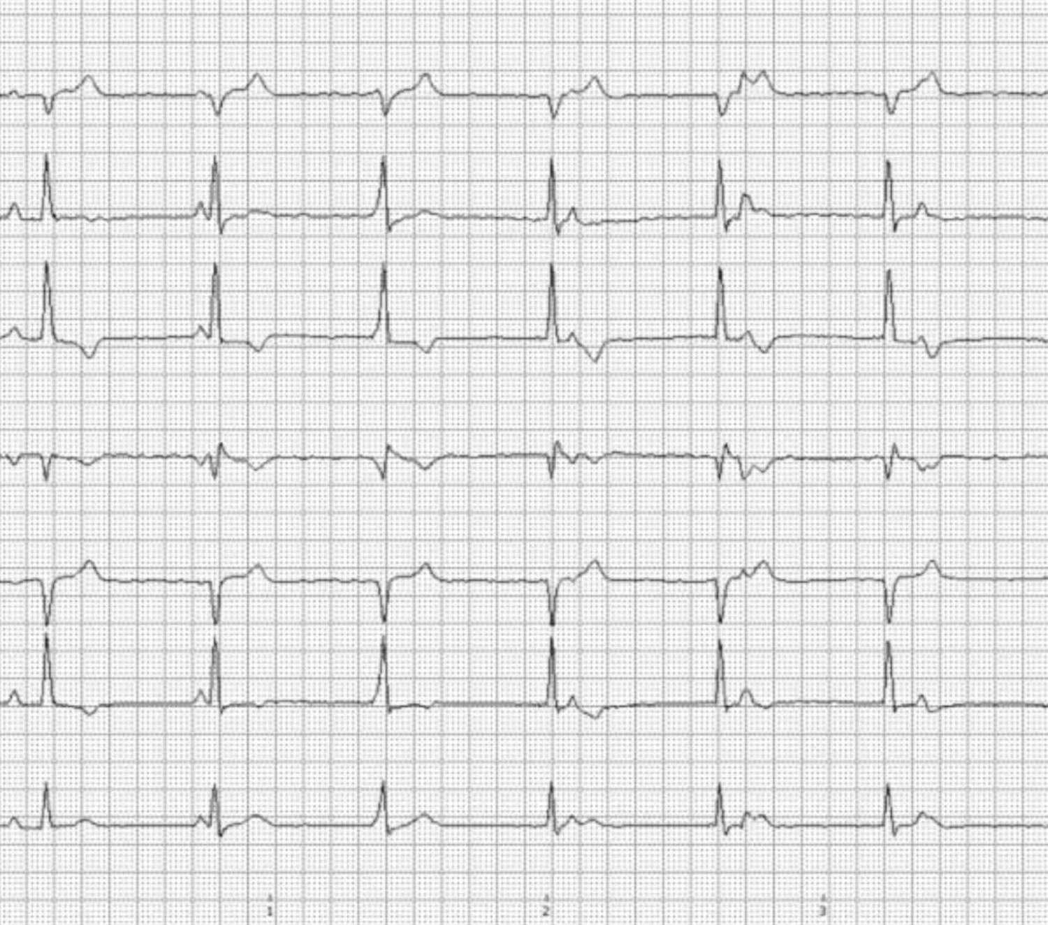 EKG-Diagramm